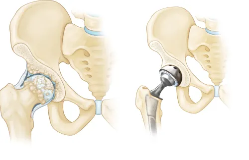 Newer materials in Knee Replacement Surgery service image
