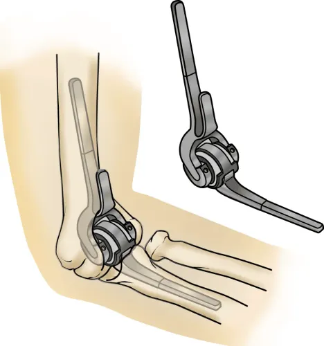 Elbow Replacement Surgery service image