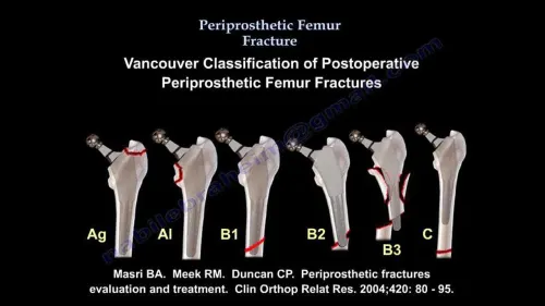 Periprosthetic Fracture Management service image
