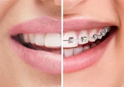Braces & Aligners  service image
