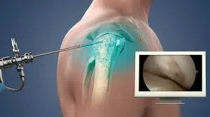 Shoulder Arthroscopy service image