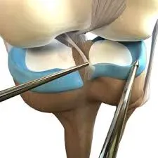 Meniscal Repair service image