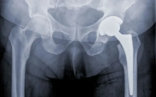 Total Hip Replacement service image