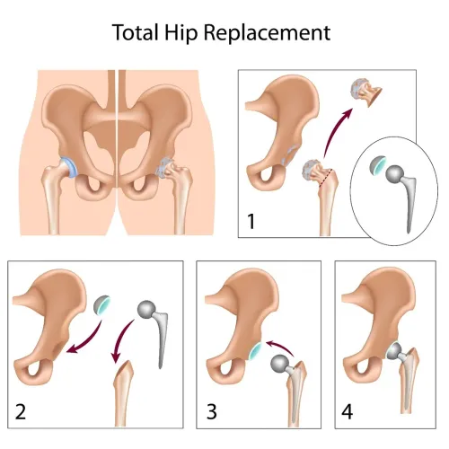 Revision Hip Replacement service image