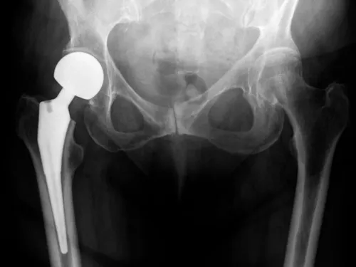 Hip Replacement in the Elderly service image