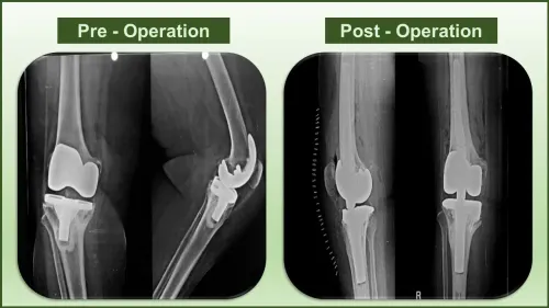 Revision Knee Replacement Surgery service image