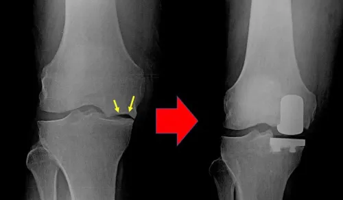 Partial Knee Replacement Surgery service image