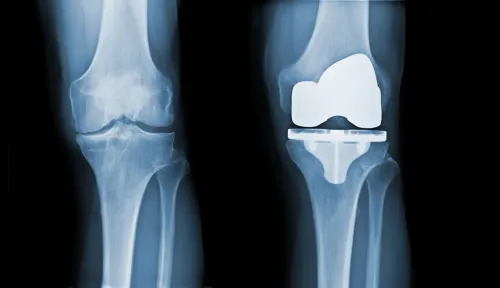 Total Knee Replacement service image