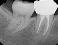 Root Canal Treatment service image