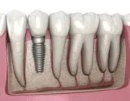 Dental Implants service image