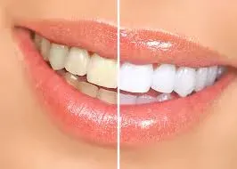 Teeth Whitening service image