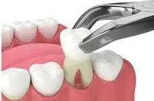 Painless Extraction service image