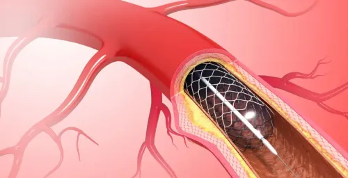 Angioplasty in Erandwane, Pune service image