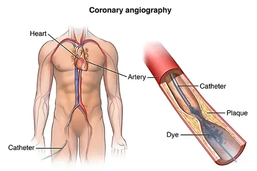 Angiography in Erandwane, Pune service image