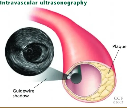 Intravascular Ultrasound (IVUS) in Erandwane, Pune service image