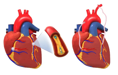 Bypass Surgery (CABG) in Erandwane, Pune service image