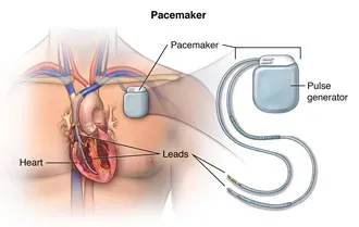 Pacemaker Implantation in Erandwane, Pune service image