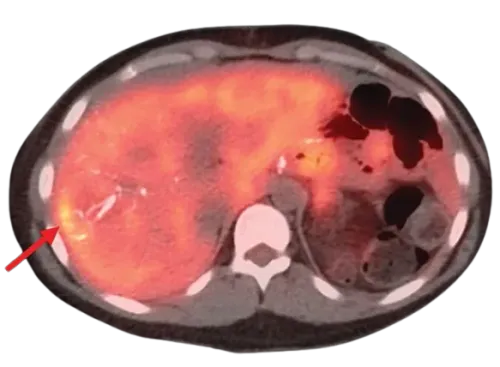 Neuroendocrine tumors NEN Treatment in Mumbai service image