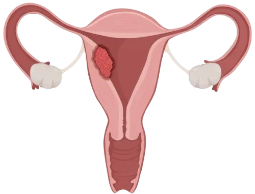 Gynaecological Cancers Surgeon in Mumbai service image