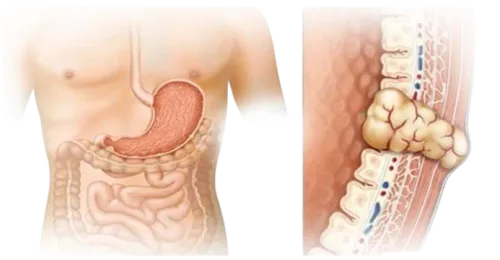 Gastrointestinal Stromal Tumors GIST Treatment in Mumbai service image