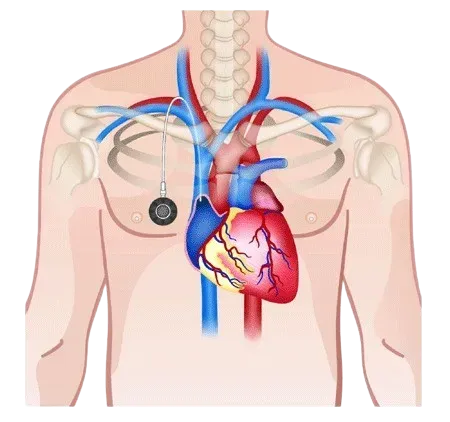 Chemoport Insertion (To facilitate Chemotherapy) service image