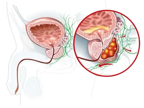 Robotic Cancer Surgery in Mumbai service image