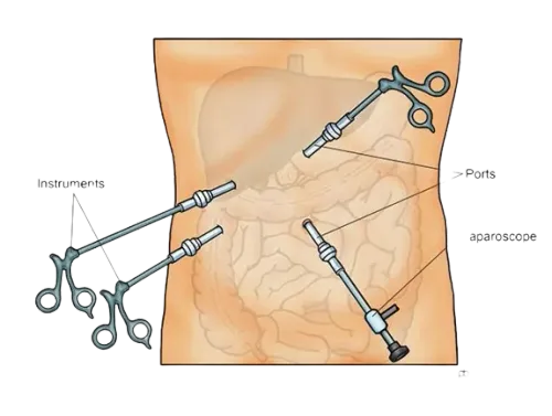 Minimally Invasive Laparoscopic Surgeries in Mumbai service image