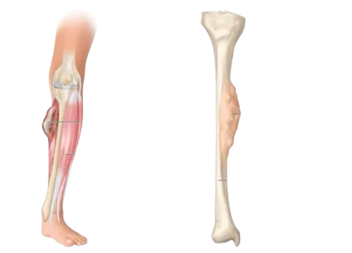 Soft Tissue Sarcomas Treatment in Mumbai service image