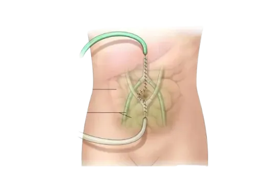 HIPEC Surgery in Vile Parle,Mumbai service image