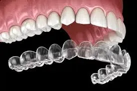Invisalign service image