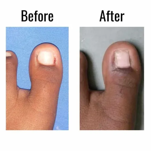 1.In-grown toe nail surgery service image