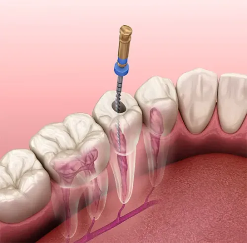 Root canal treatment  in Kharadi , Wadgaon Sheri service image