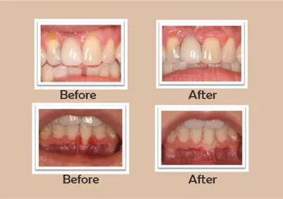 Periodontal surgery treatment in Kharadi , Wadgaon Sheri service image