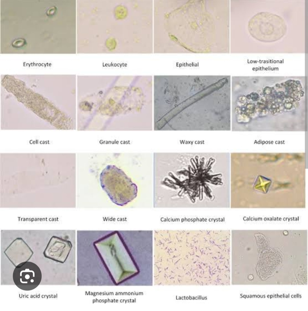 A32➡️Urine Routine Microscopy 