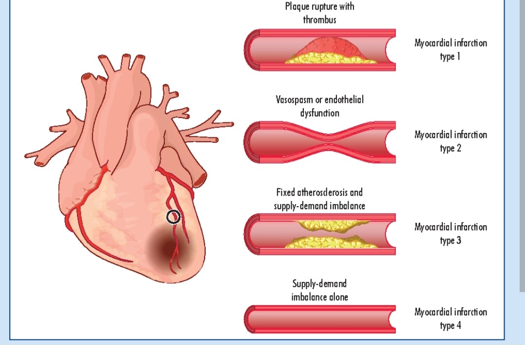 A96➡️Troponin T