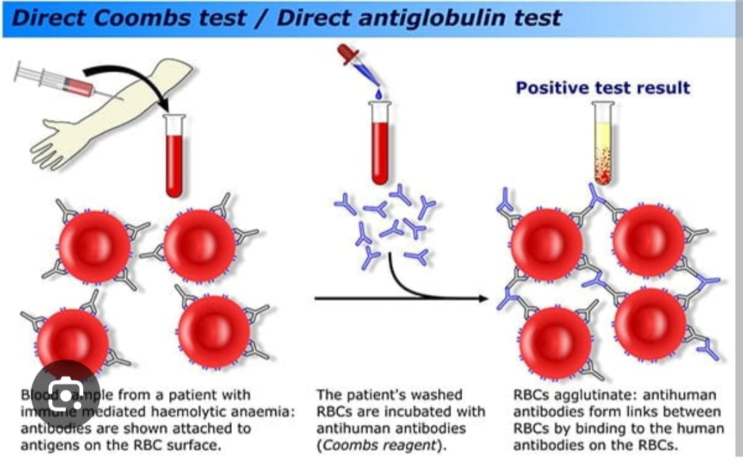 A129➡️DCT, or Direct Coombs Test (direct antiglobulin test)