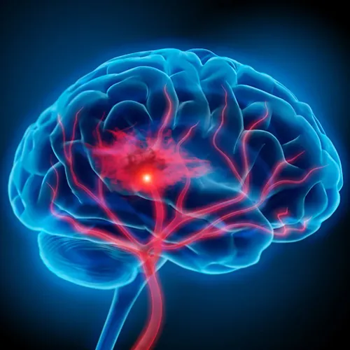 Neuro Vascular Surgery service image
