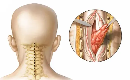 Spinal Tumor service image