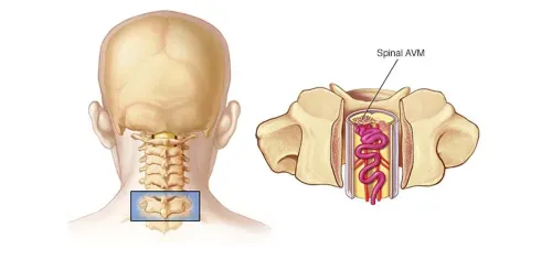 Spine Vascular Malformation Surgeries service image
