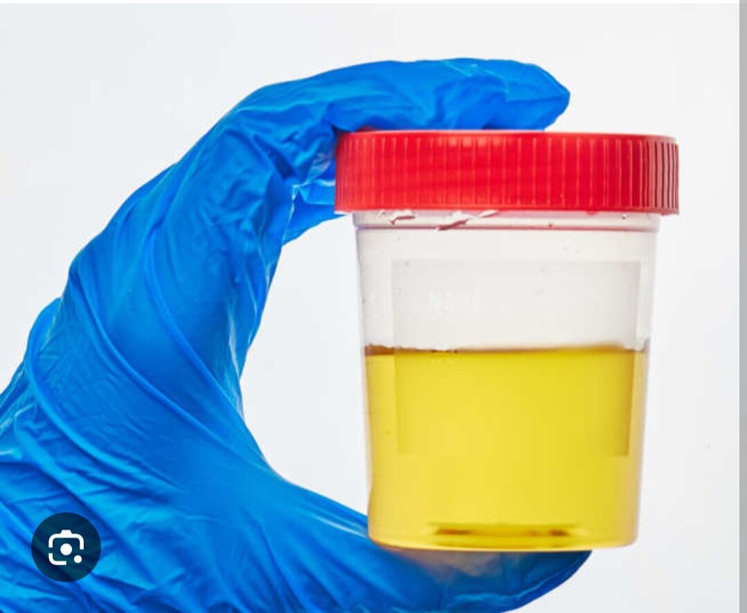 A241➡️Urine Alcohol 