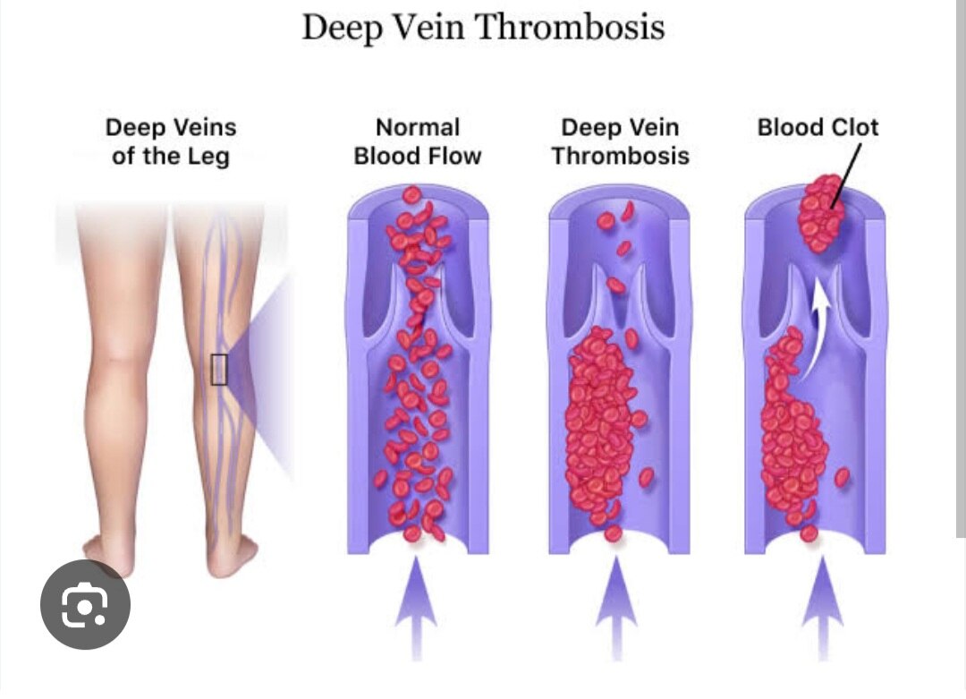 A243➡️DVT (Deep Vein Thrombosis)