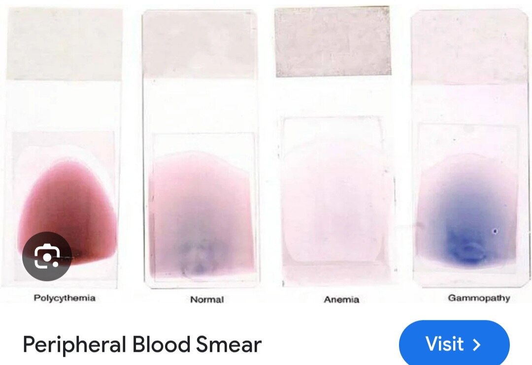 A255➡️Peripheral Blood Smear (PBS)