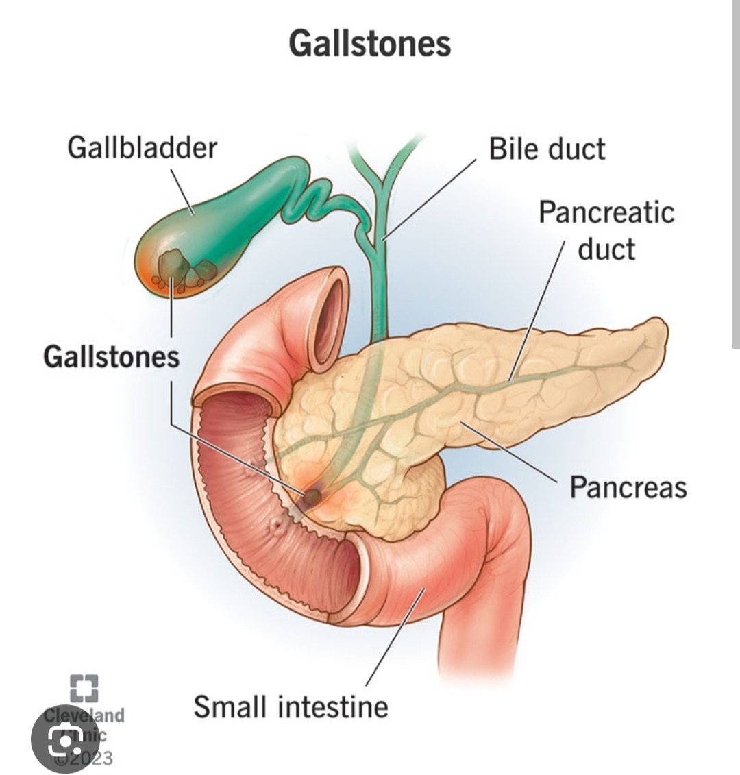 A261➡️(Stone Analysis, Gall bladder calculus)