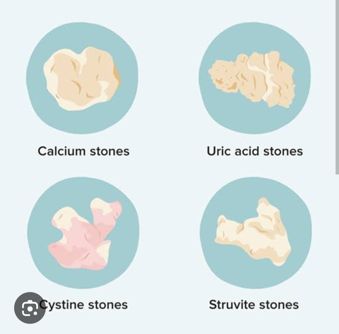 A262➡️Stone Analysis, Other calculus