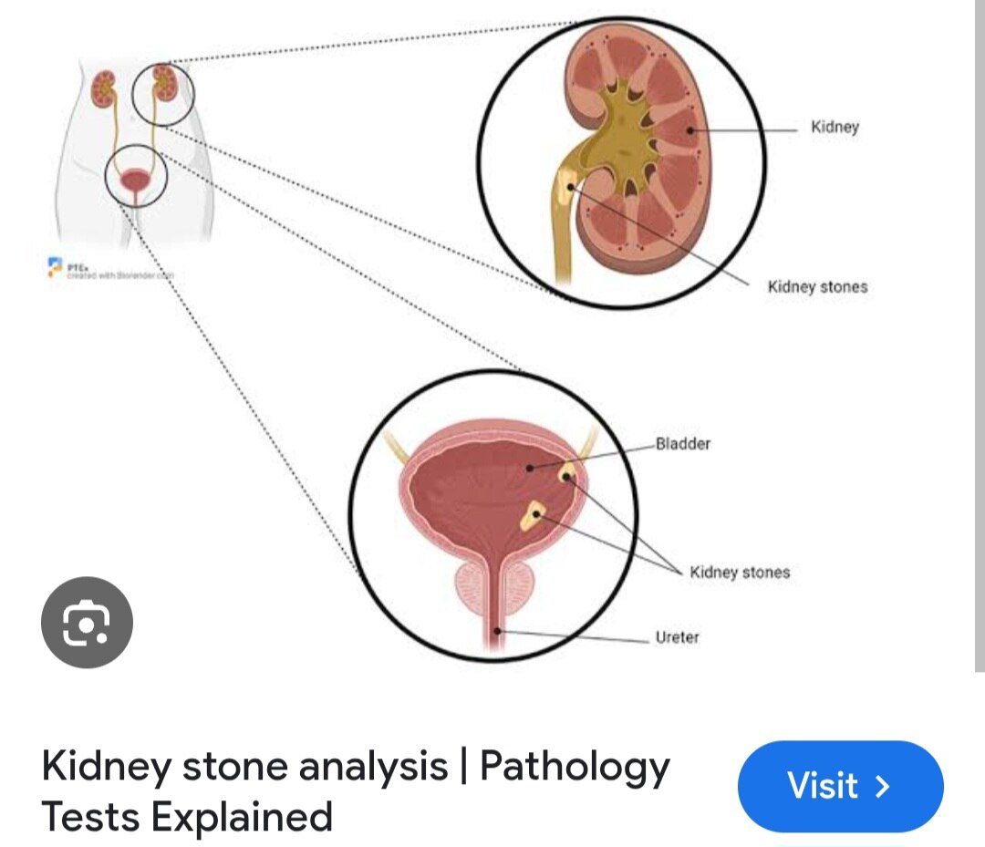 A263➡️Stone Analysis, Urine calculus