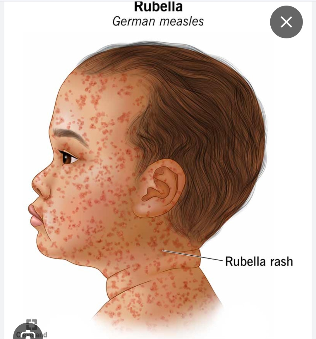 A289➡️Rubella (German Measles) - IgG & IgM antibody, Serum