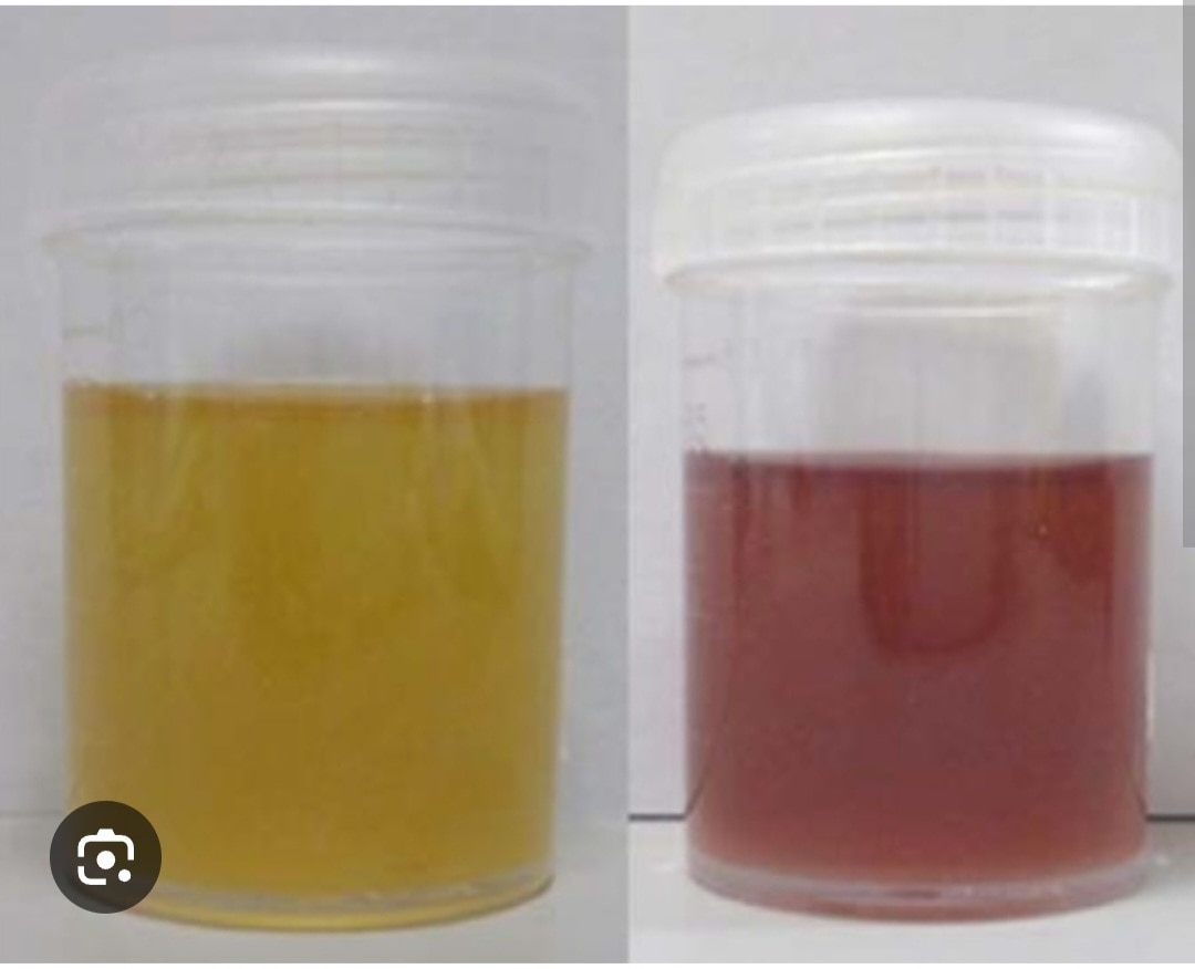 A298➡️Porphyria Profile, Urine