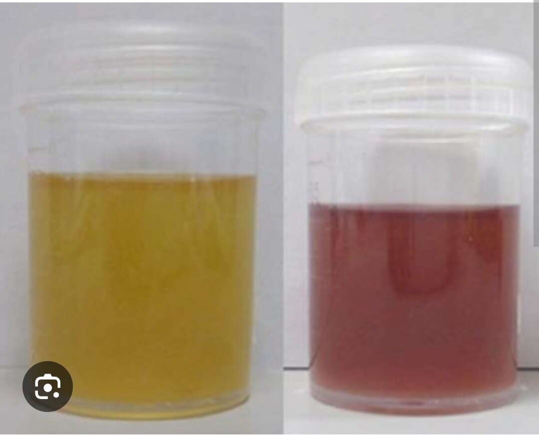 A299➡️Porphyria Profile, Urine 24 Hrs