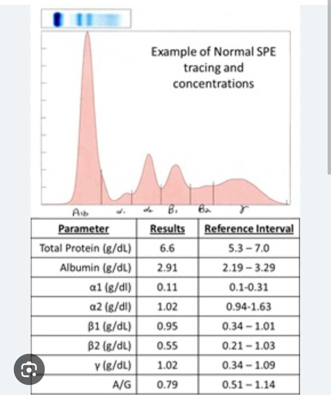A302➡️Protein Electrophoresis,Serum