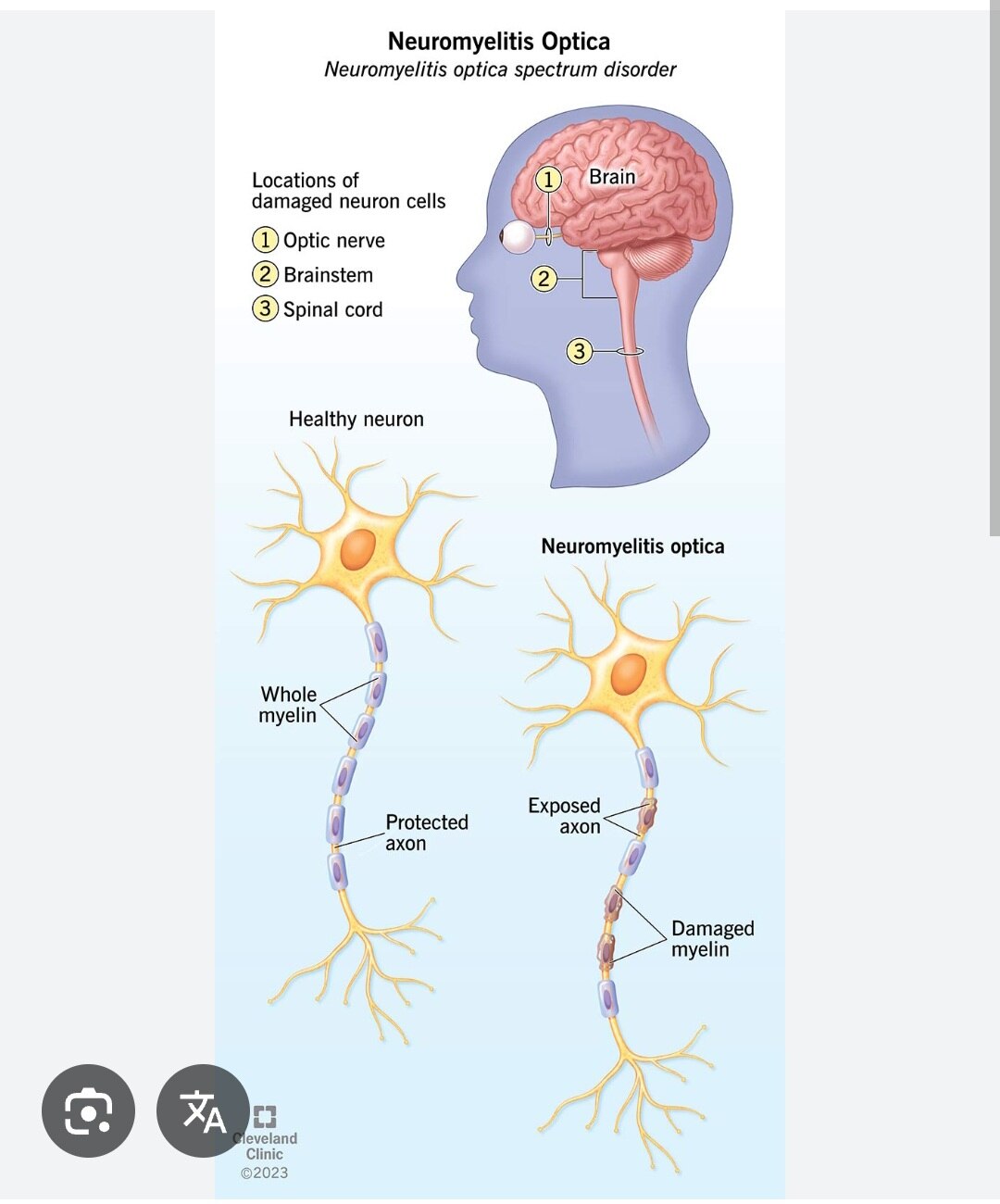 A312➡️NMO with MOG Antibody Profile, Serum
